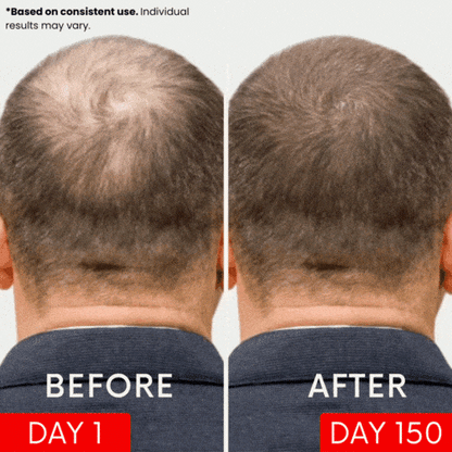AKYGO® Red Light Therapy Hat – Comprehensive Hair Growth &amp; Scalp Health Solution